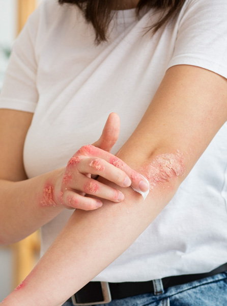Eczema